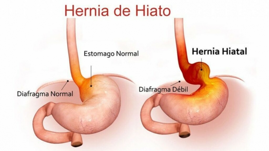 Hernia de Hiato: causas, síntomas y tratamiento